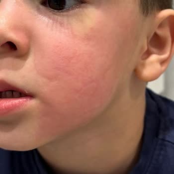 Mustela Arnica Jel Krem İle Beklenmedik Alerjik Reaksiyon