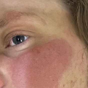 Hametan Krem Yüzde Kızarıklık Ve Yanma Yaptı