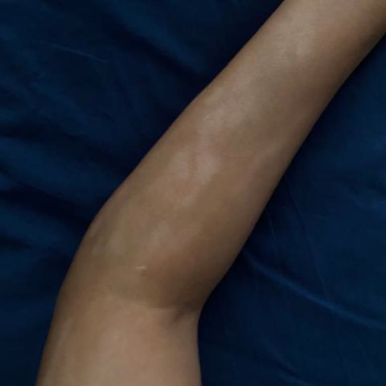 Larissa Güzellik Merkezi Batman Lazer Epilasyon Şikayeti