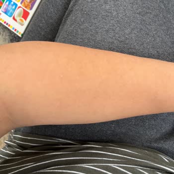 Yanıklar Ve Hamilelik Nedeniyle Kullanılamayan Paket