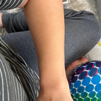 Yanıklar Ve Hamilelik Nedeniyle Kullanılamayan Paket