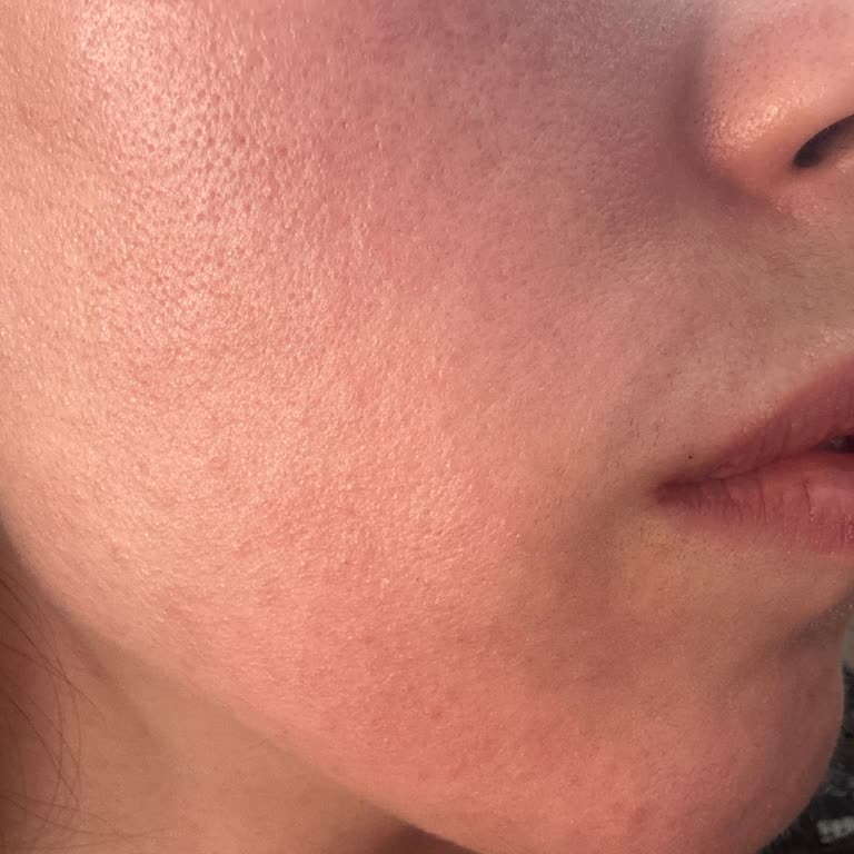 Sinoz Leke Kremi Yüzümde Şişlik Ve Kaşıntıya Neden Oldu