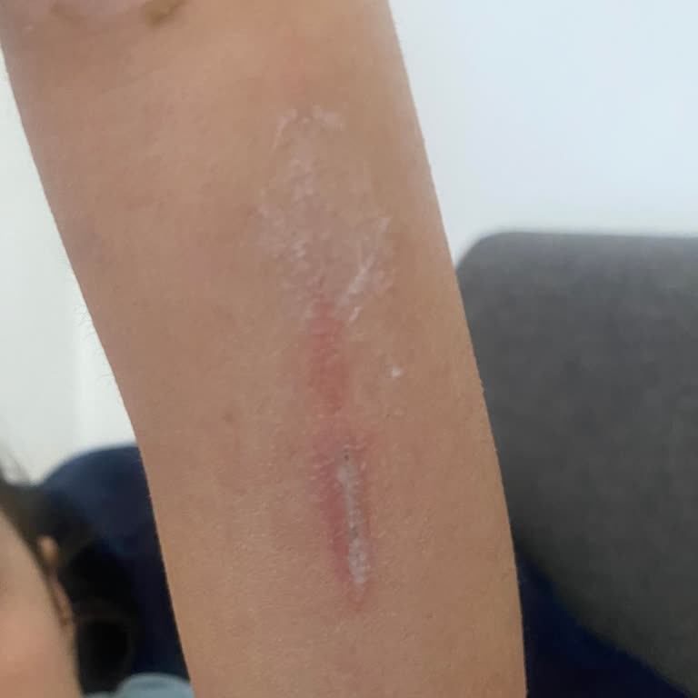 Hastanede Alçı Çıkartma Kabusu: Kızımın Kolunu Kanattılar!