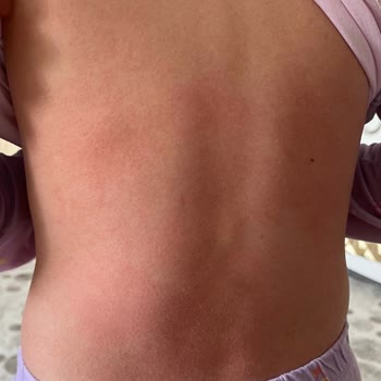 Çocuğumun Sağlığı Tehlikede: Yan Etkilerle Karşılaştık!