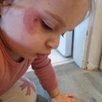 Mustela Arnica Jel Kalitesizliği