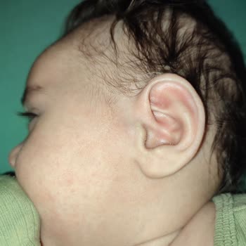 Bebeğimde Alerjik Reaksiyona Neden Olan Krem