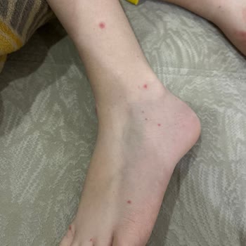 Oğlumda Vitamin Takviyesi Sonrası Alerjik Reaksiyon