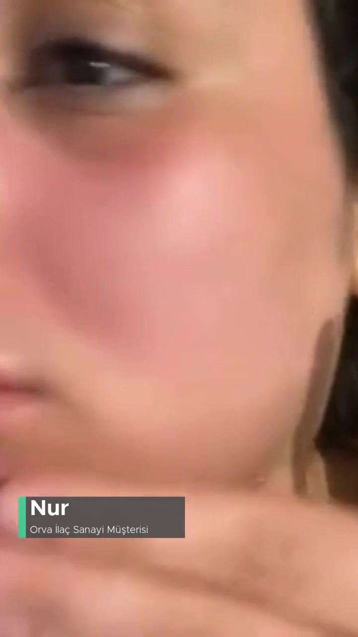 Expigment Krem Yüzümü Yaktı videonun kapak resmi