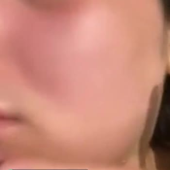 Expigment Krem Yüzümü Yaktı