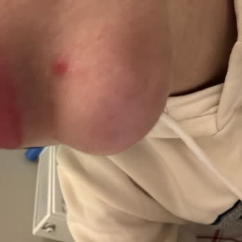 Pure Beauty Güneş Kremi İle Cilt Sorunları