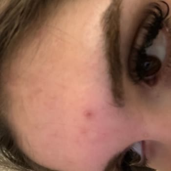 Pure Beauty Güneş Kremi İle Cilt Sorunları