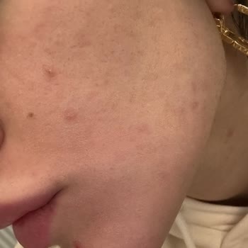 Pure Beauty Güneş Kremi İle Cilt Sorunları