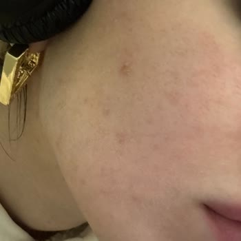 Pure Beauty Güneş Kremi İle Cilt Sorunları