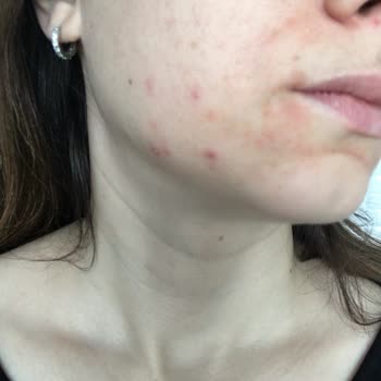 Cream Co Mavi Nemlendirici Cilt Sorunlarına Yol Açtı