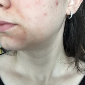 Cream Co Mavi Nemlendirici Cilt Sorunlarına Yol Açtı