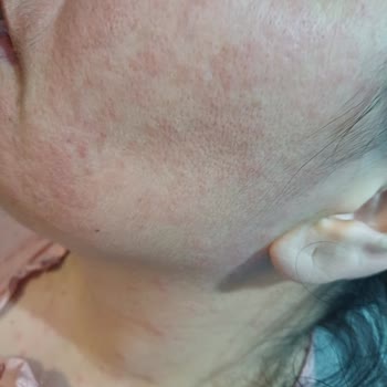 Bozuk Ürün Yüzümde Sorun Yarattı