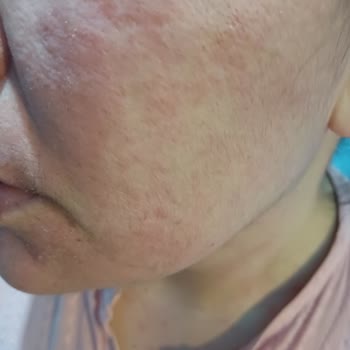 Bozuk Ürün Yüzümde Sorun Yarattı