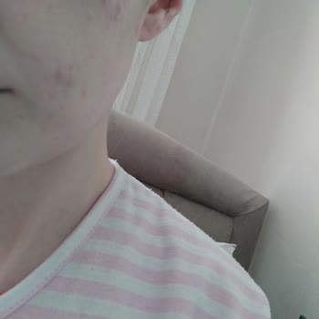 BB Krem Felaketi: Sivilceler Ve İade Sorunu!