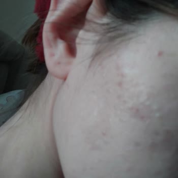 BB Krem Felaketi: Sivilceler Ve İade Sorunu!