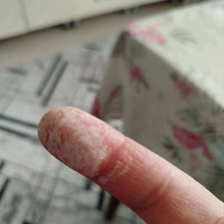 Vanish Kosla Kullanımı Sonrası Cilt Tahribatı!