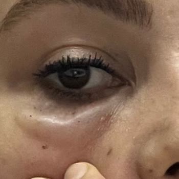 Gözaltı Dolgusu Kabusu: Vizyon Güzellik Salonu'nda Yaşadıklarım