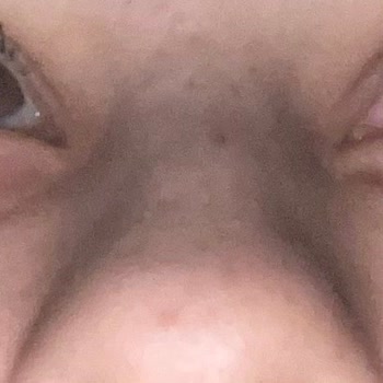 Gözaltı Dolgusu Kabusu: Vizyon Güzellik Salonu'nda Yaşadıklarım