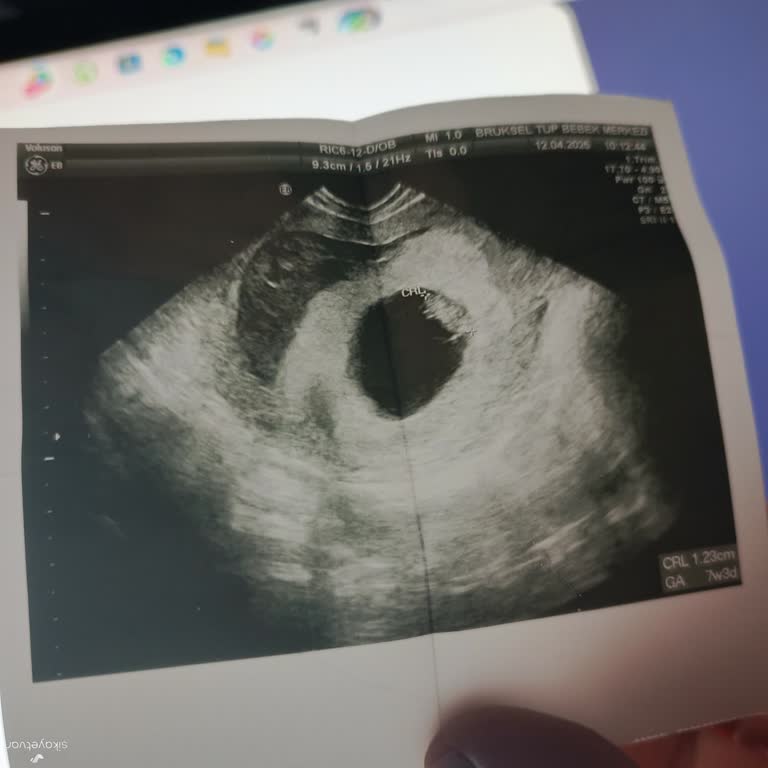 Bahat Hastaneleri'nde Sağlık Skandalı: Anne Karnında İç Kanama!