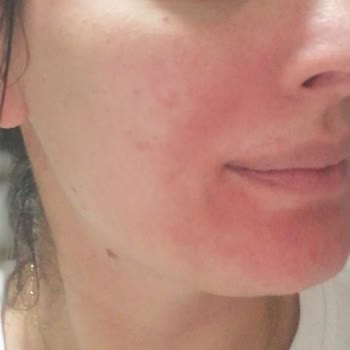 Cilt Bakım Ürünlerinde Hayal Kırıklığı Ve Cilt Sorunları