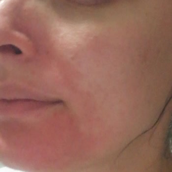 Cilt Bakım Ürünlerinde Hayal Kırıklığı Ve Cilt Sorunları