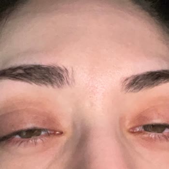 Kiko Rimel Kullanımı Sonrası Göz Şişmesi