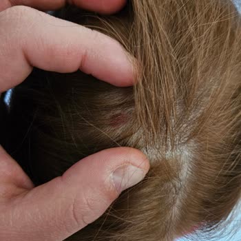 Küllü Sarı Boya Sonrası Saç Derisinde Yaralar