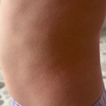 Enterogermina Kids Alerji Yaptı, Acil Çözüm Bekliyoruz