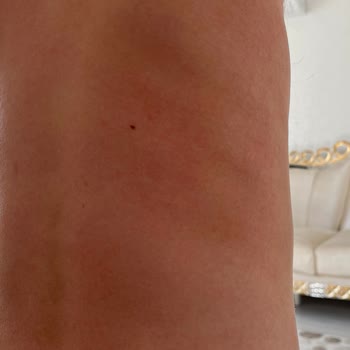 Enterogermina Kids Alerji Yaptı, Acil Çözüm Bekliyoruz