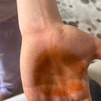 Enterogermina Kids Alerji Yaptı, Acil Çözüm Bekliyoruz