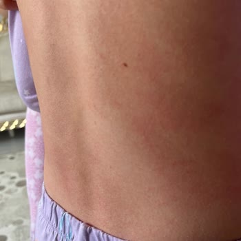 Enterogermina Kids Ürünü Alerji Yaptı