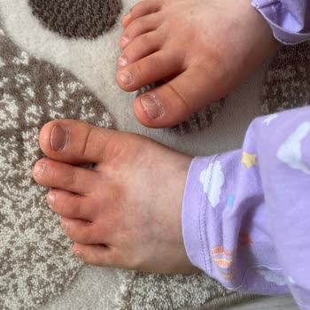 Enterogermina Kids Ürünü Alerji Yaptı