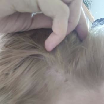 Schwarzkopf Burned My Scalp With Palette 10 1 Hair Dye Despite Proper Use