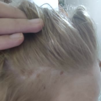 Schwarzkopf Burned My Scalp With Palette 10 1 Hair Dye Despite Proper Use