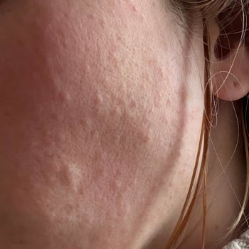 Yves Rocher Nemlendirici Krem Alerji Sorunu