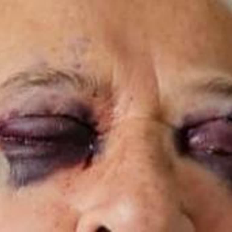 Göz Kapağı Estetiği Sonrası Görme Kaybı