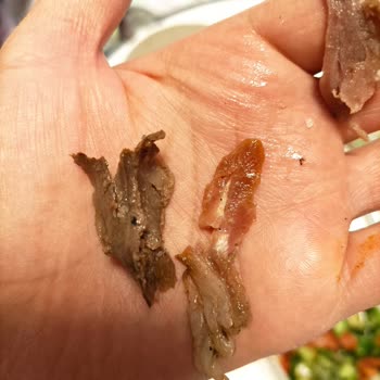 Çiğ Döner Ve Yabancı Cisim Şoku