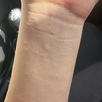 Elidor Ürünleri Alerjik Reaksiyona Neden Oldu!