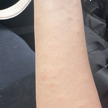 Elidor Ürünleri Alerjik Reaksiyona Neden Oldu!