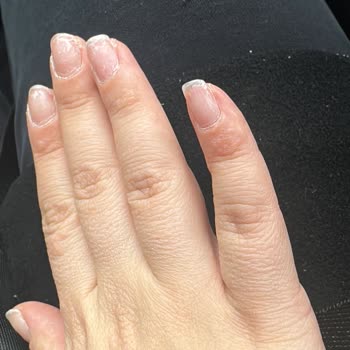 Elidor Ürünleri Alerjik Reaksiyona Neden Oldu!