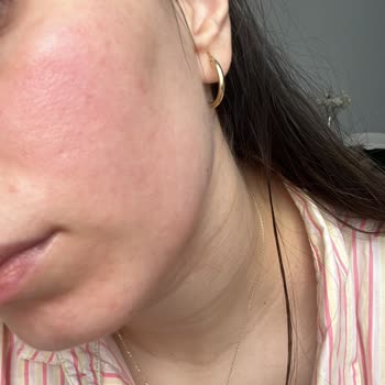 Ciltte Kalıcı Kızarıklık Ve Kabarmalar