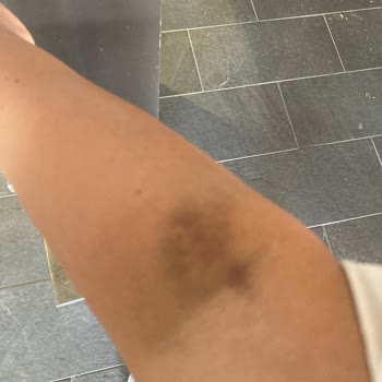 Acil Serviste Yetersiz Damar Yolu Açma Deneyimi