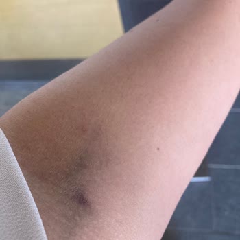 Acil Serviste Yetersiz Damar Yolu Açma Deneyimi