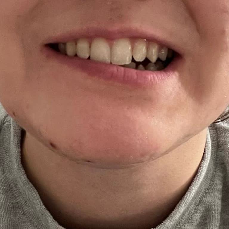 Uzm. Dr. Ekin Aykan Gıdı Lipoliz Enjeksiyonunda Yaşanan Sorunlar!