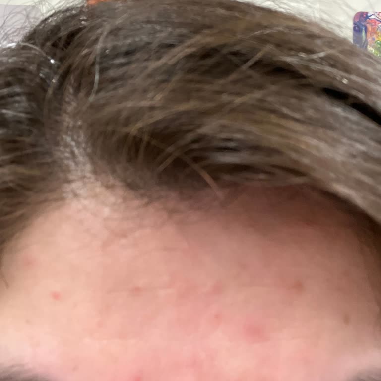 Loreal Paris C Vitamini Serum Cildimde Sorun Yarattı!