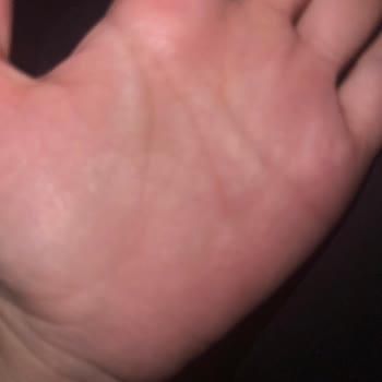 Konak Şampuanı Alerji Problemi